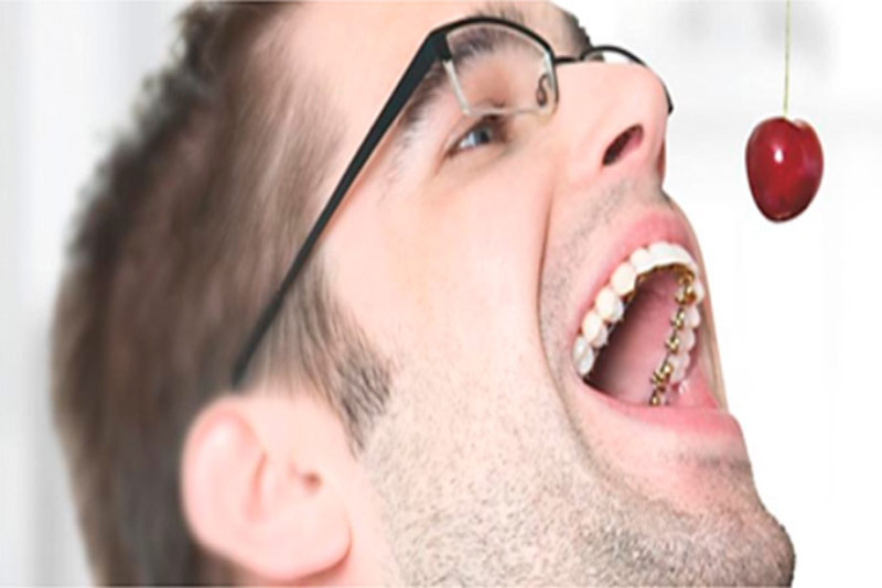 Muaks dental care, lingual Braces . Rodrigo Castillo Muaks dental care, lingual Braces . Rodrigo Castillo